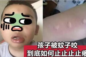 寶寶被蚊子咬了塗花露水、風油精？兒科醫生：錯！試試這幾招