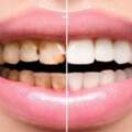 若想讓牙齒美白，10個小妙招可別錯過了，第一招最簡單