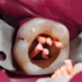 牙齒殺神經到底有多痛？