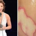 瑞瑪席丹領金馬新演員獎時「網友發現她肩膀有燒燙傷」，搜尋後發現她曾遇死亡車禍全身被火吻！