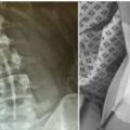 她PO出「剛做完脊椎側彎手術」恐怖照，背後「2根支架直接從肉裡捅出來」網嚇：不敢翹腳了！