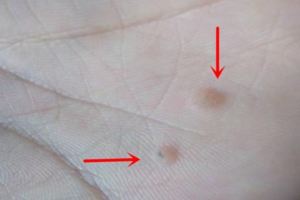 瘊子長在手上不痛不癢但很難看？教你一招，一周對難看煩人的它說再見