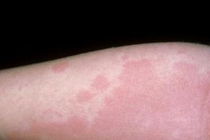 為什麼蕁麻疹總是反復發作？這6點或是「幕後黑手」