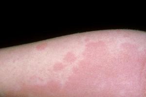 為什麼蕁麻疹總是反復發作？這6點或是「幕後黑手」