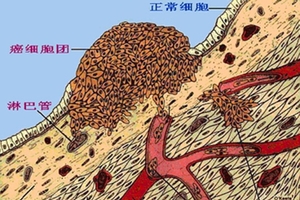 請多喝熱開水：因為癌像感冒一樣普遍： 日本新發現殺癌細胞的方法，原來就是常喝這個！