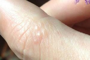 很多人都沒發現！「手指」突然出現這種小水泡…竟是大病前兆！！千萬要小心了…