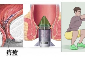 太好了，痔瘡終於有解了！教你三種方法自然消除，人人都能不再癢！只要這樣做...