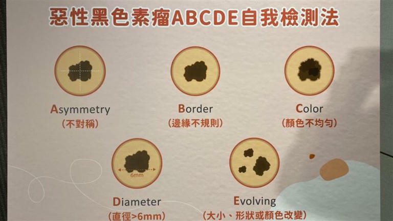 民眾可參考惡性黑色素瘤「ABCDE」自我檢查指標。(圖/記者簡浩正攝影) 民眾可參考惡性黑色素瘤「ABCDE」自我檢查指標。(圖/記者簡浩正攝影)