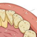 嘴裡有「牙結石」不僅臭，還有什麼表現？為什麼會長，如何消除？