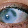 眼睛是癌細胞的「感應器」，若眼睛出現這3種異常，儘早檢查