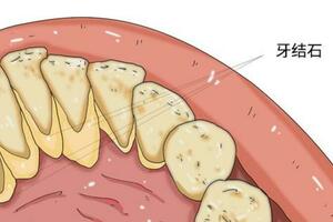 嘴裡有「牙結石」不僅臭，還有什麼表現？為什麼會長，如何消除？