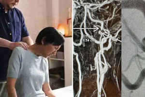 30歲男泰式按摩　「7天後一眼失明」頸動脈撕裂！醫籲四類人小心