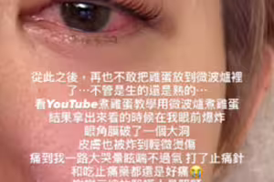 女星微波雞蛋變炸蛋！「角膜破大洞、皮膚燙傷」慘況曝光