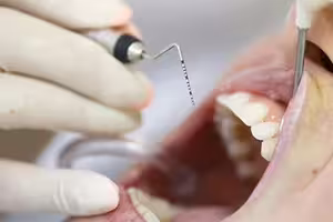 蛀牙會傳染！醫認了「情侶病」真的存在　網驚：禿頭也會