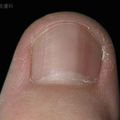 皮膚癌徵兆！皮膚科醫師：指甲有黑線警惕皮膚癌