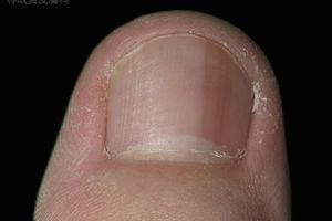 皮膚癌徵兆！皮膚科醫師：指甲有黑線警惕皮膚癌