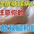 醫生提醒「糖尿病人」：如果你的腳和眼出現這些癥狀，併發症要來了！千萬注意！