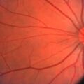 55歲，患糖尿病15年，視力開始下降，糖尿病患者到底應如何保護雙眼