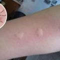 被蚊子叮過總是腫一包又越抓越癢，教你三招止癢方法，60秒後止癢去痕！