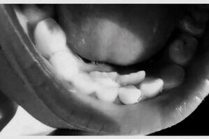 因為奶奶這個習慣，6歲女童長了雙排牙！嚴重會引起心肌炎、腎炎