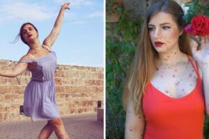 一出生就害爸媽吵翻　「星星印記」正妹靠芭蕾找回自信：這是驕傲的印記