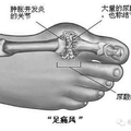 協助父母告別痛風，不吝嗇，請分享。。