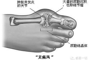 協助父母告別痛風，不吝嗇，請分享。。