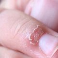 你的手指常常脫皮「倒刺指」嗎？千萬不要直接把皮撕下來，你應該要這樣做才對！