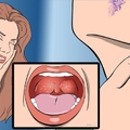 你的“喉嚨”常又干又緊嗎？要特別小心了！！可能是這種“癌症”早期征狀…