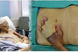為了救這個爺爺，醫生決定把他的手跟肚子縫在一起。當手最後終於拿出來時…WOW！