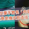 4歲女童手臂長「肉環」　原因竟是橡皮筋