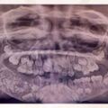 印度7歲男孩下顎腫脹，醫生從他口中拔出了526顆牙