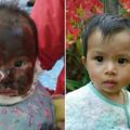1歲小孩臉被熱水嚴重燙傷媽媽以為沒救了，直到她發現「這種神奇的東西」竟然治好到連疤都不留！