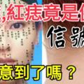 黑痣、紅痣竟是健康「信號燈」，你注意到了嗎？