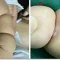 寶寶剛出生三個月，胖嘟嘟的，醫生卻說要做截肢手術!