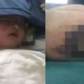 內蒙古3歲兒童得怪病　整個後背被「食肉菌」吃掉一塊