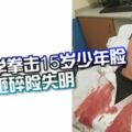 悲！惡霸同學拳擊15歲少年臉眼鏡被砸碎險失明！