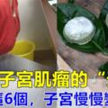 子宮肌瘤不可怕！醫生：多食6種食物，能活血去淤，調節【雌☆激☆素】，讓你的子宮慢慢恢復健康！