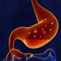 關於膽汁反流性胃炎，你不得不知的幾點