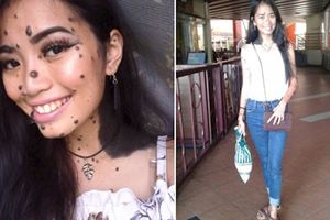 全身長滿黑痣被嘲笑為「chipsmore」她鼓足勇氣參選大馬環球小姐！