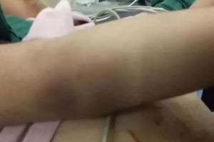 3歲女童遭後媽虐死顱內出血腹部扎滿針眼