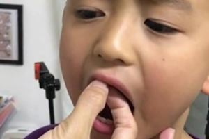 張柏芝親自幫兒子拔牙，小Q沒大門牙更可愛了