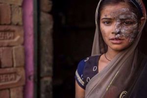 發現父親的秘密後，印度女孩被父親潑硫酸毀容
