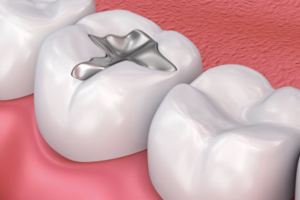 以後可能不需要補牙了！研究：牙能借力再生