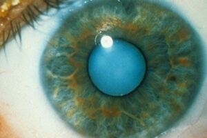 新的眼藥水可以溶解白內障:不需要進行手術