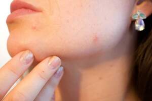 臉發黃是肝炎引起的黃疸所致？會不會傳染給孩子，一文告知