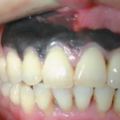 牙齒上出現這種症狀，你就要小心腫瘤了！黑色素瘤發展到晚期，就會隨著血流向肺部、肝髒、骨骼、腦部等器官轉移