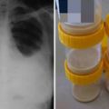 他抽菸抽到整個肺部都是「又稠又黃的膿」讓醫生都看傻了眼，清完後的結果還是死…