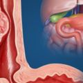 什麼信號提示食管癌復發了？食道癌復發有什麼症狀？