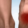 腳後跟疼怎麼回事？5個方法緩解疼痛